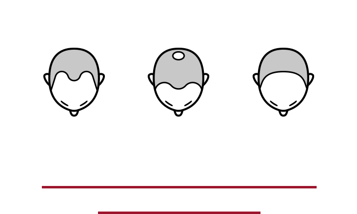 薄毛の悩みの多くはAGAが原因 AGAは壮年性脱毛症または男性型脱毛症といわれる症状で、髪が細くなり脱毛とともに薄毛が進行します。男性の薄毛の多くはこのAGAによって引き起こされています。