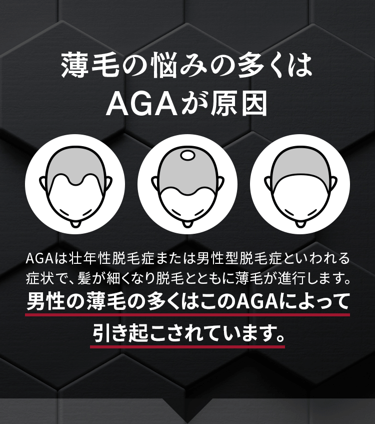 薄毛の悩みの多くはAGAが原因 AGAは壮年性脱毛症または男性型脱毛症といわれる症状で、髪が細くなり脱毛とともに薄毛が進行します。男性の薄毛の多くはこのAGAによって引き起こされています。
