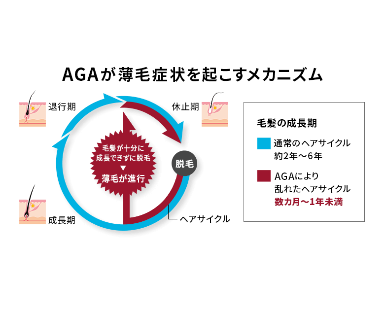AGAは進行性！自然には治りません。 AGAが薄毛症状を起こすメカニズム AGAは『ヘアサイクル』の乱れによって、毛髪が十分に成長する前に抜け落ち、薄毛症状が起こります。 また、AGAは進行性ですので、早めに対応することで効果が表れやすく、満足度の高い改善が見込める傾向があります。 進行が重症化すると改善に時間がかかったり、満足のいくレベルの効果が得られない場合もあります。 ですから早めに対策することが重要です。